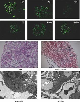 Potential Roles of Oral Microbiota in the Pathogenesis of Immunoglobin A Nephropathy